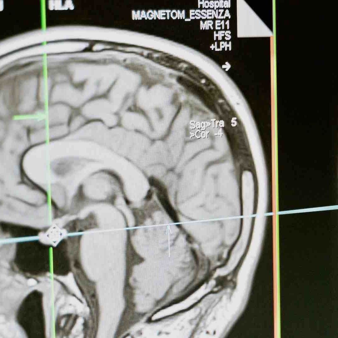 Imagen de una radiografía cerebral