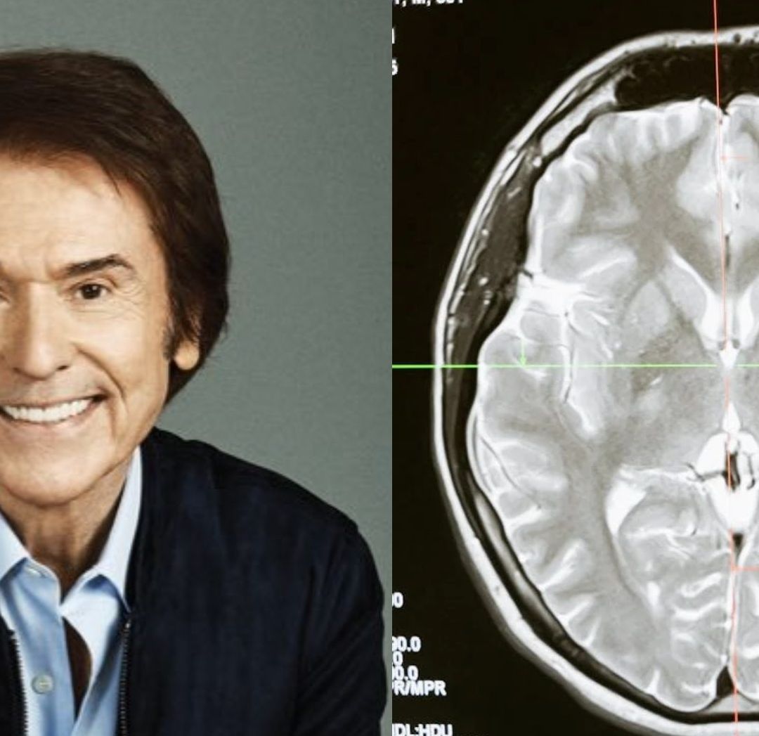 ¿Qué es un Accidente Cerebrovascular? La Causa de Hospitalización del cantante Raphael