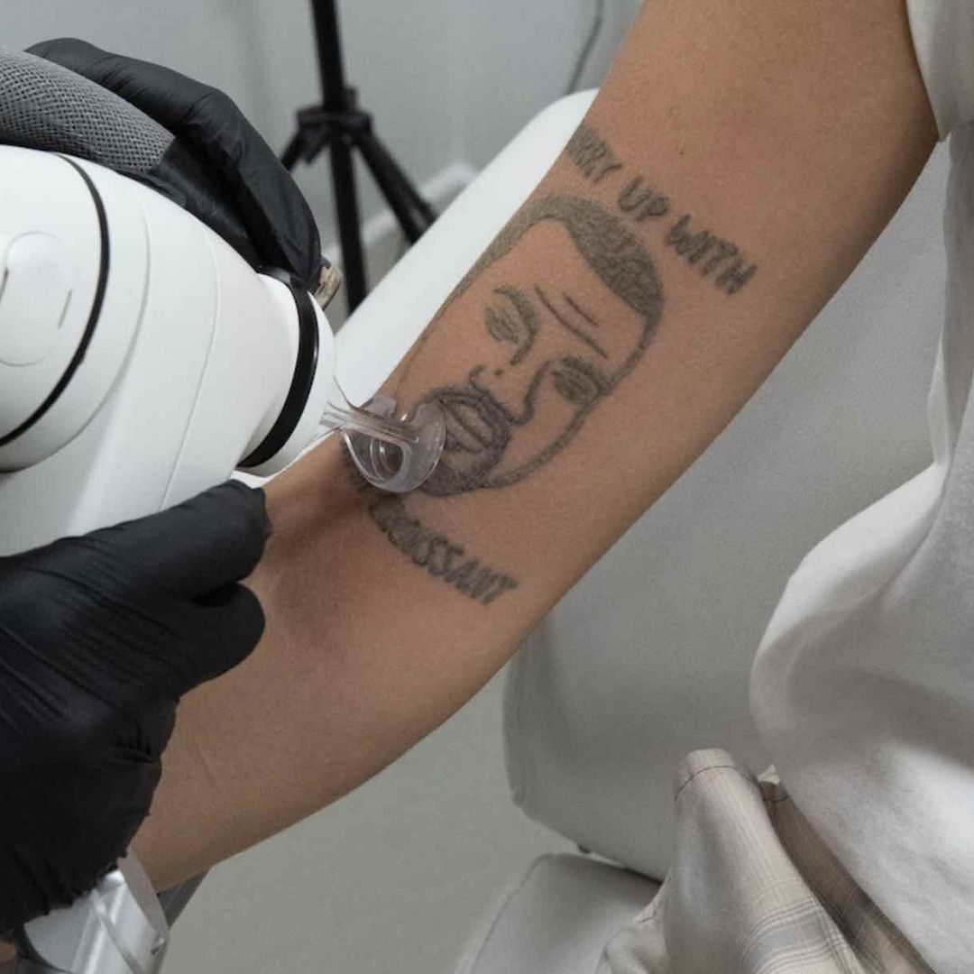 Una persona se quita un tatuaje de Kanye West