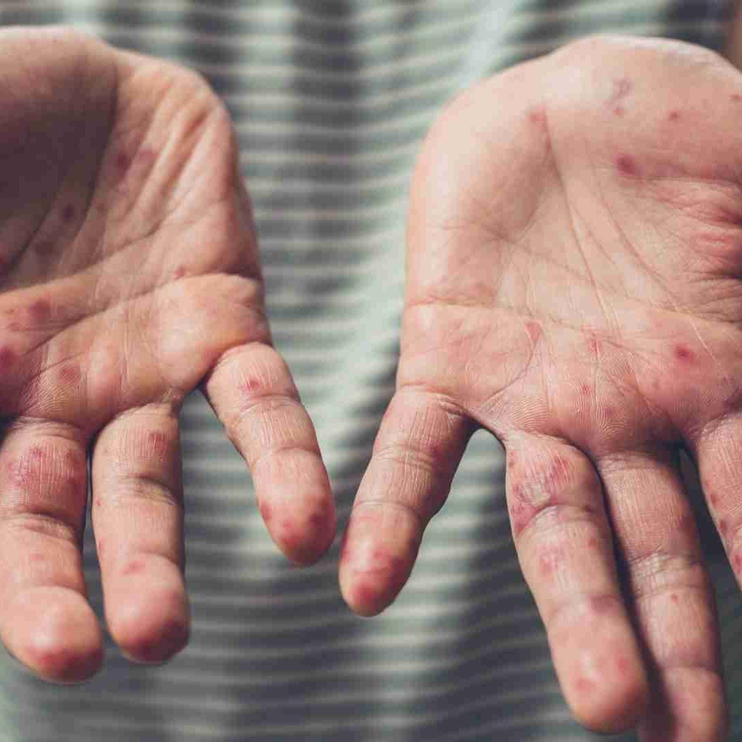 Suman 21 Casos de Sarampión en Querétaro