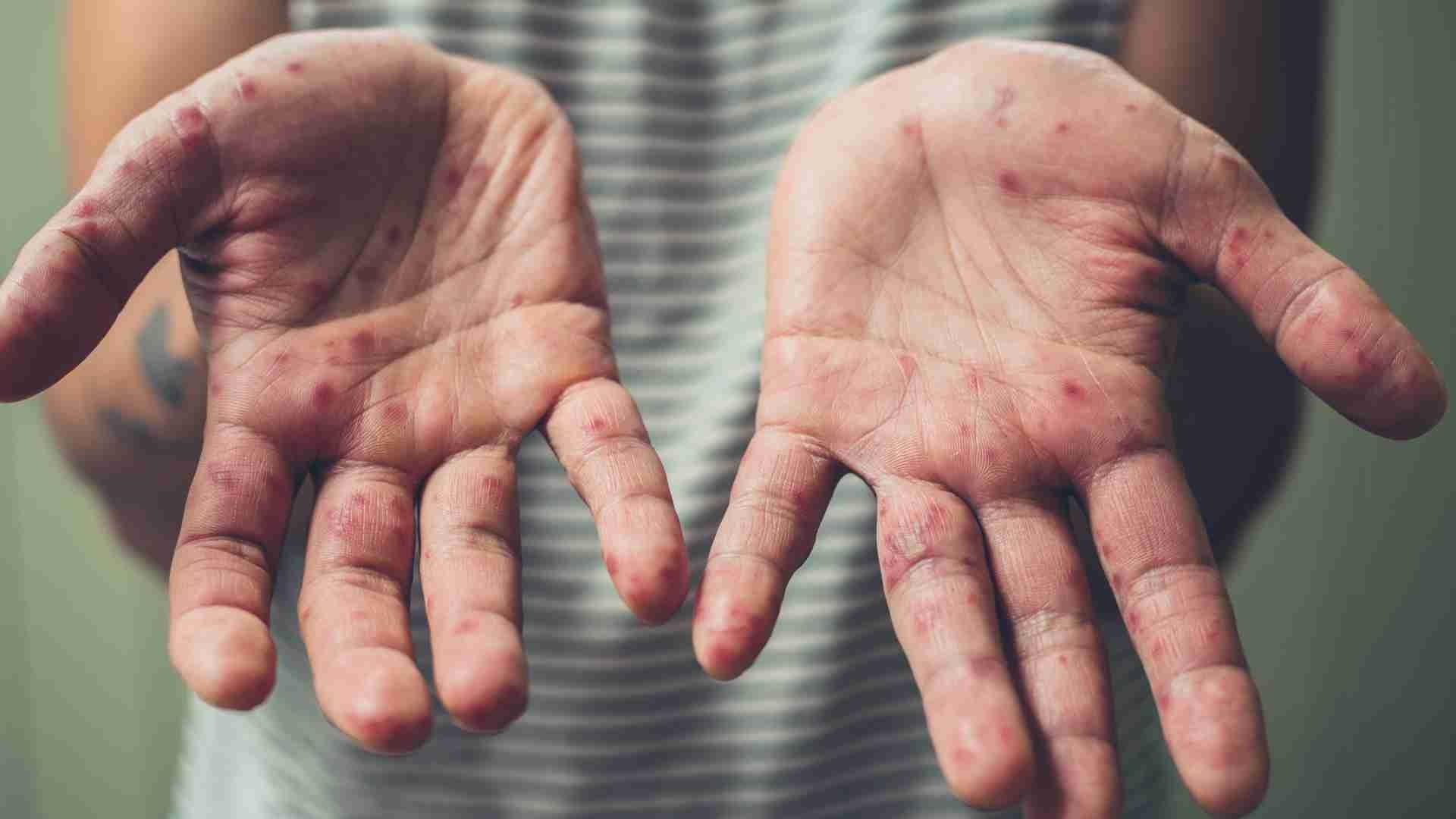 Suman 21 Casos de Sarampión en Querétaro