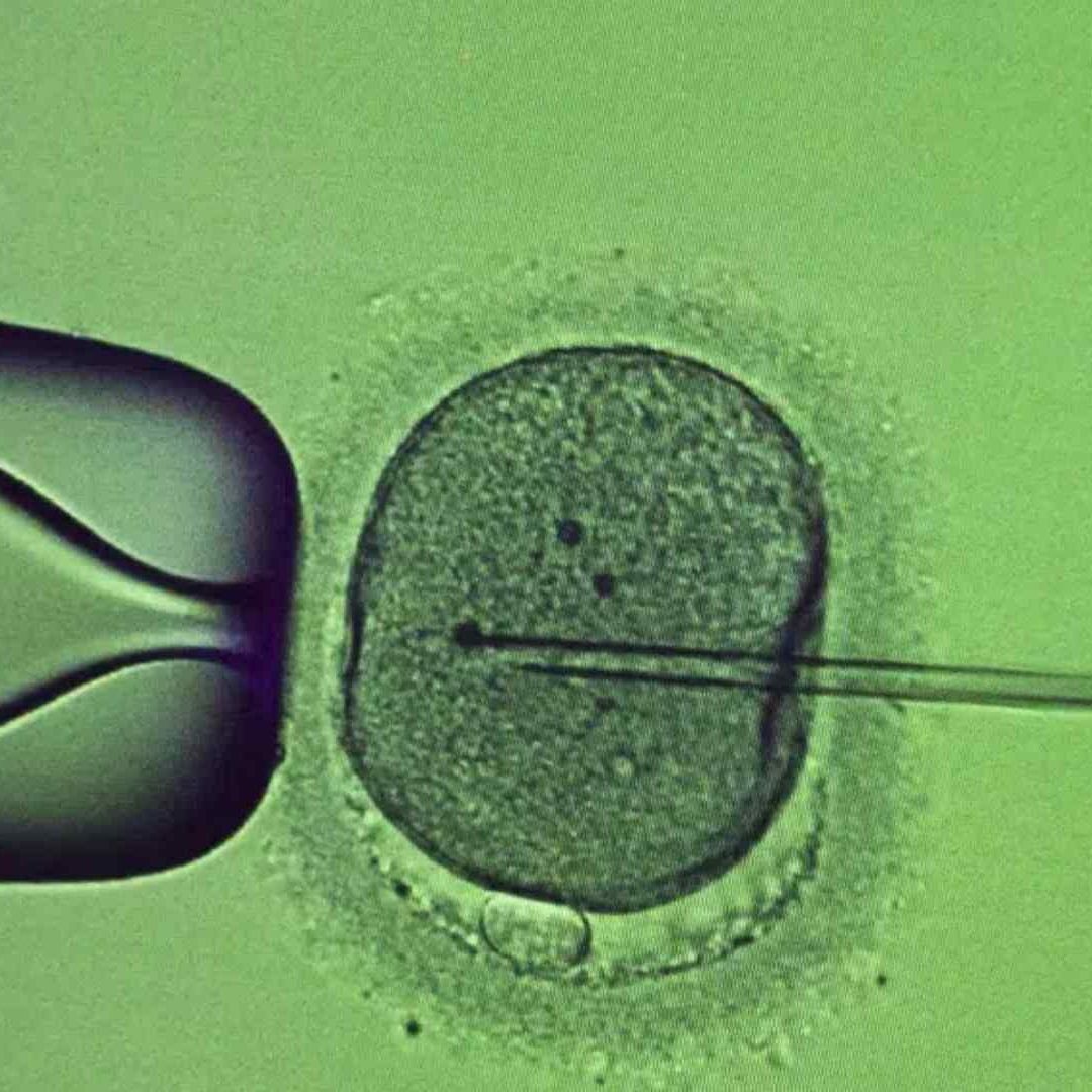 Un especialista efectúa un procedimiento de inyección intracitoplásmica de espermatozoides en una clínica de fertilidad en Ucrania