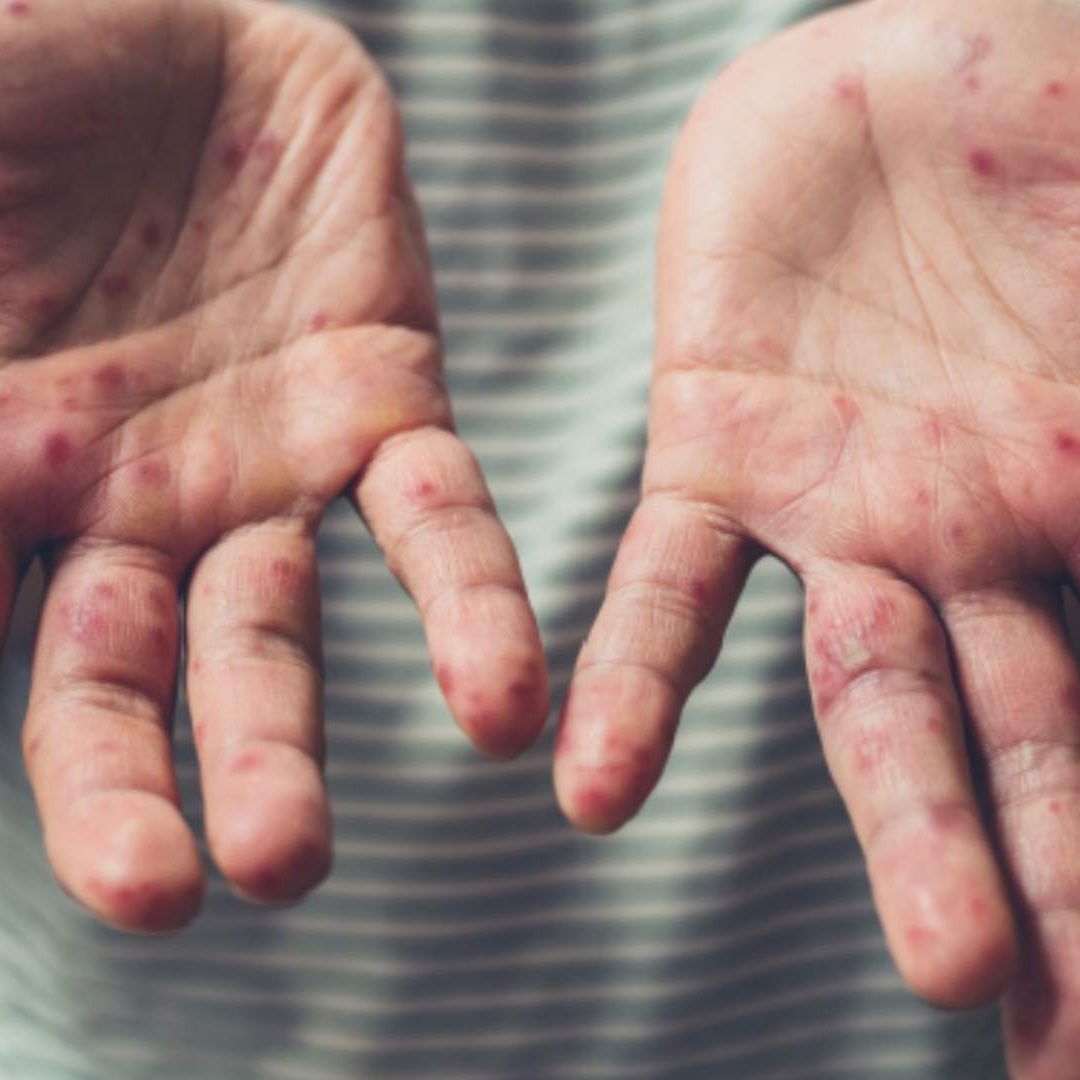 Serbia teme que el sarampión se convierta en una epidemia en el país
