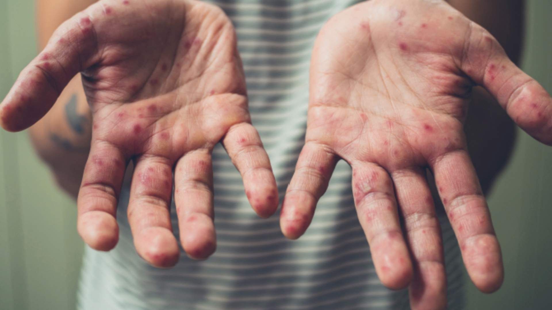 Serbia teme que el sarampión se convierta en una epidemia en el país