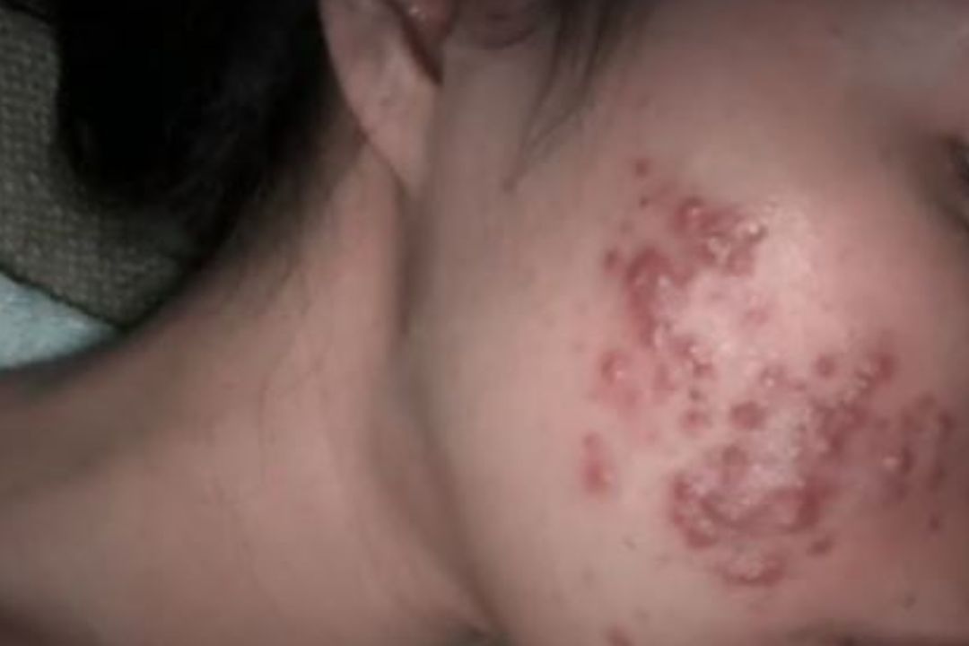 Valeria Godoy, de tan solo 23 años, aún conserva manchas en su rostro, secuelas del acné que se desató después de aplicarse maquillaje pirata