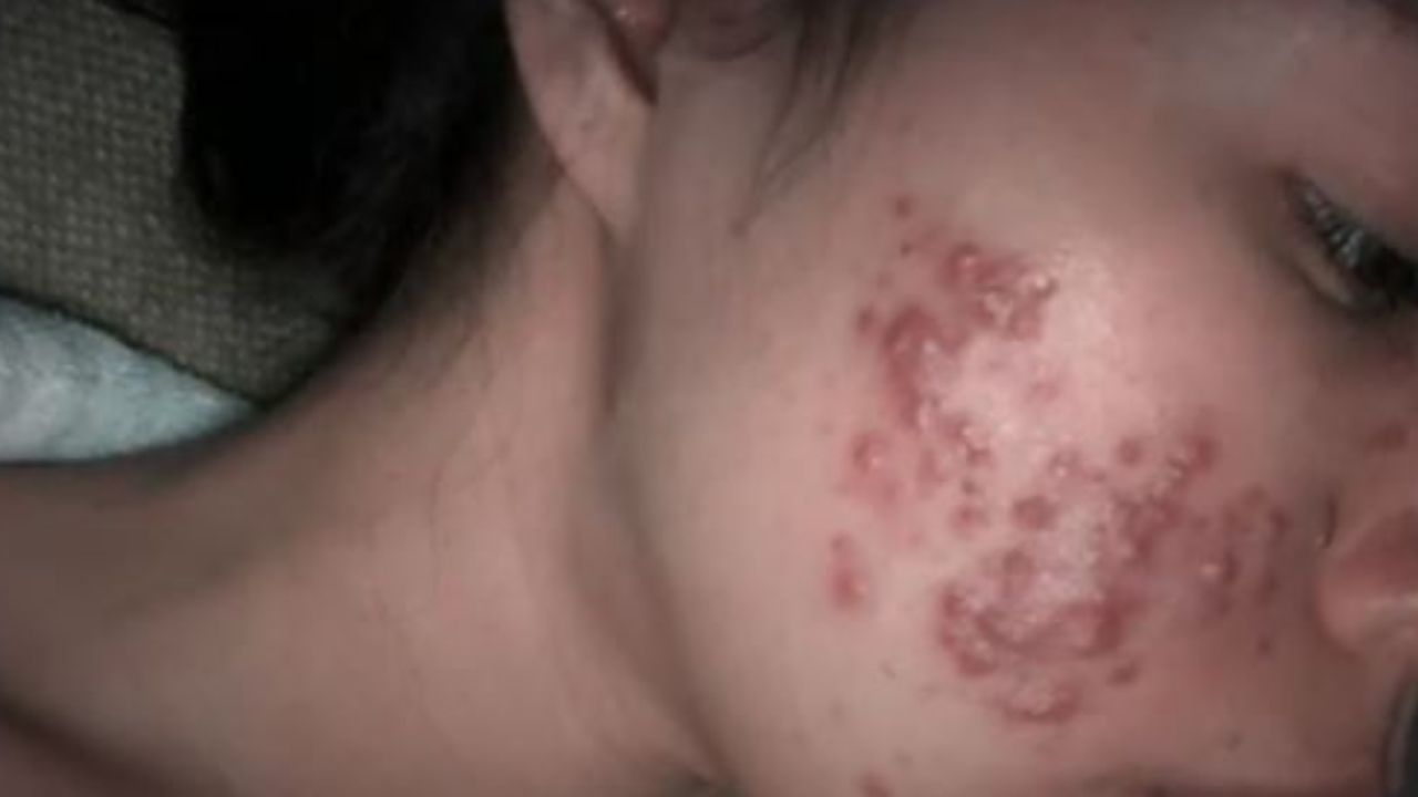 Valeria Godoy, de tan solo 23 años, aún conserva manchas en su rostro, secuelas del acné que se desató después de aplicarse maquillaje pirata