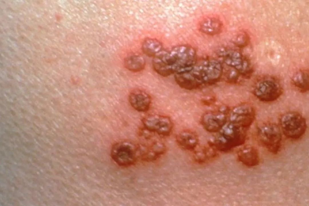 Mal manejo del estrés puede causar herpes zóster