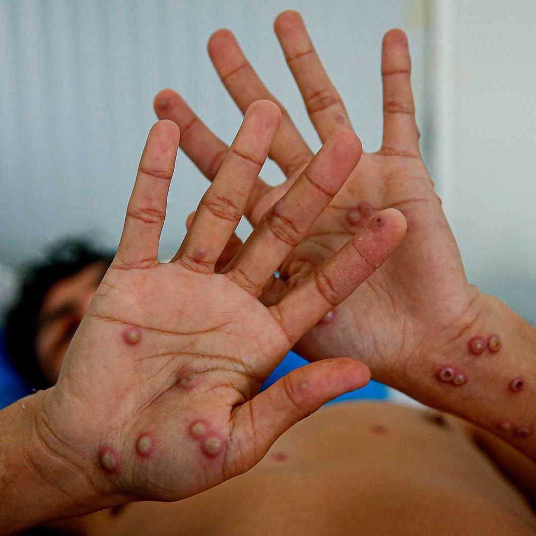 La OMS anunció que mantendrá la emergencia internacional por el mpox pese a la caída mundial de casos