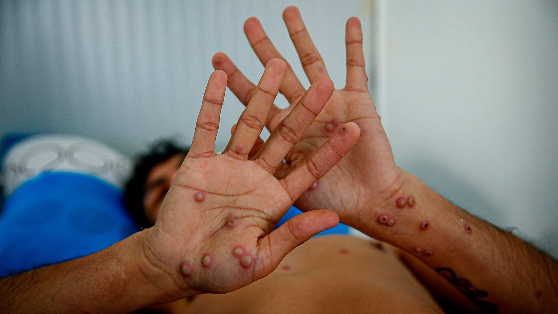 La OMS anunció que mantendrá la emergencia internacional por el mpox pese a la caída mundial de casos