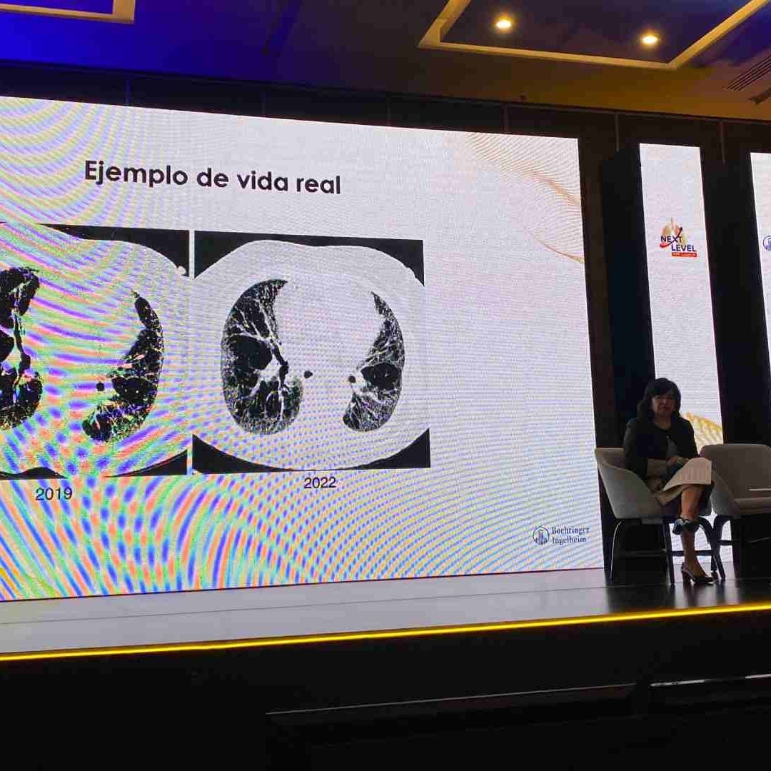 La pandemia por covid relegó la atención de tratamientos como fibrosis pulmonar