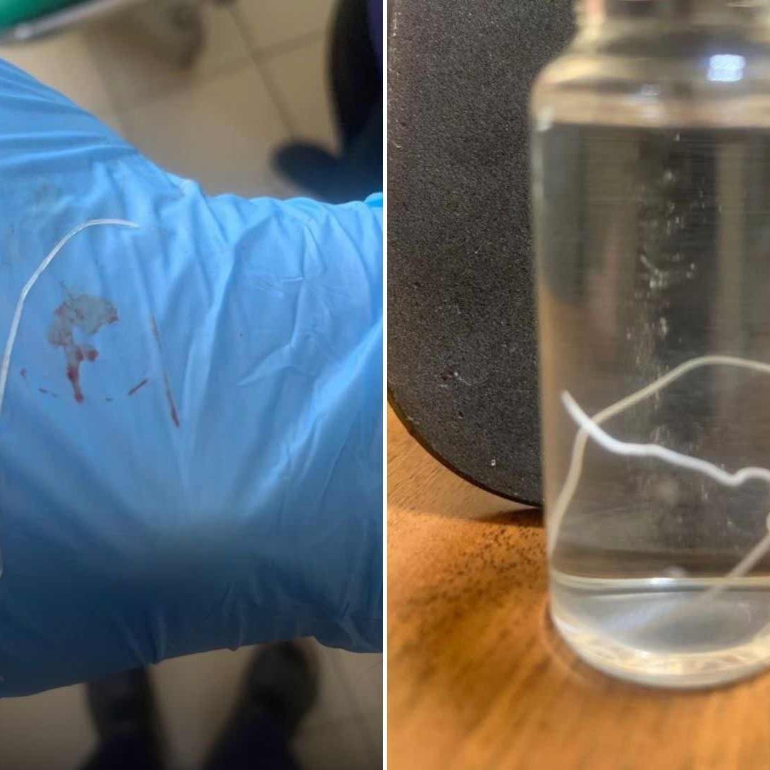 Va al Doctor por Dolor de Cabeza y le Extraen Gusano de 15 Centímetros