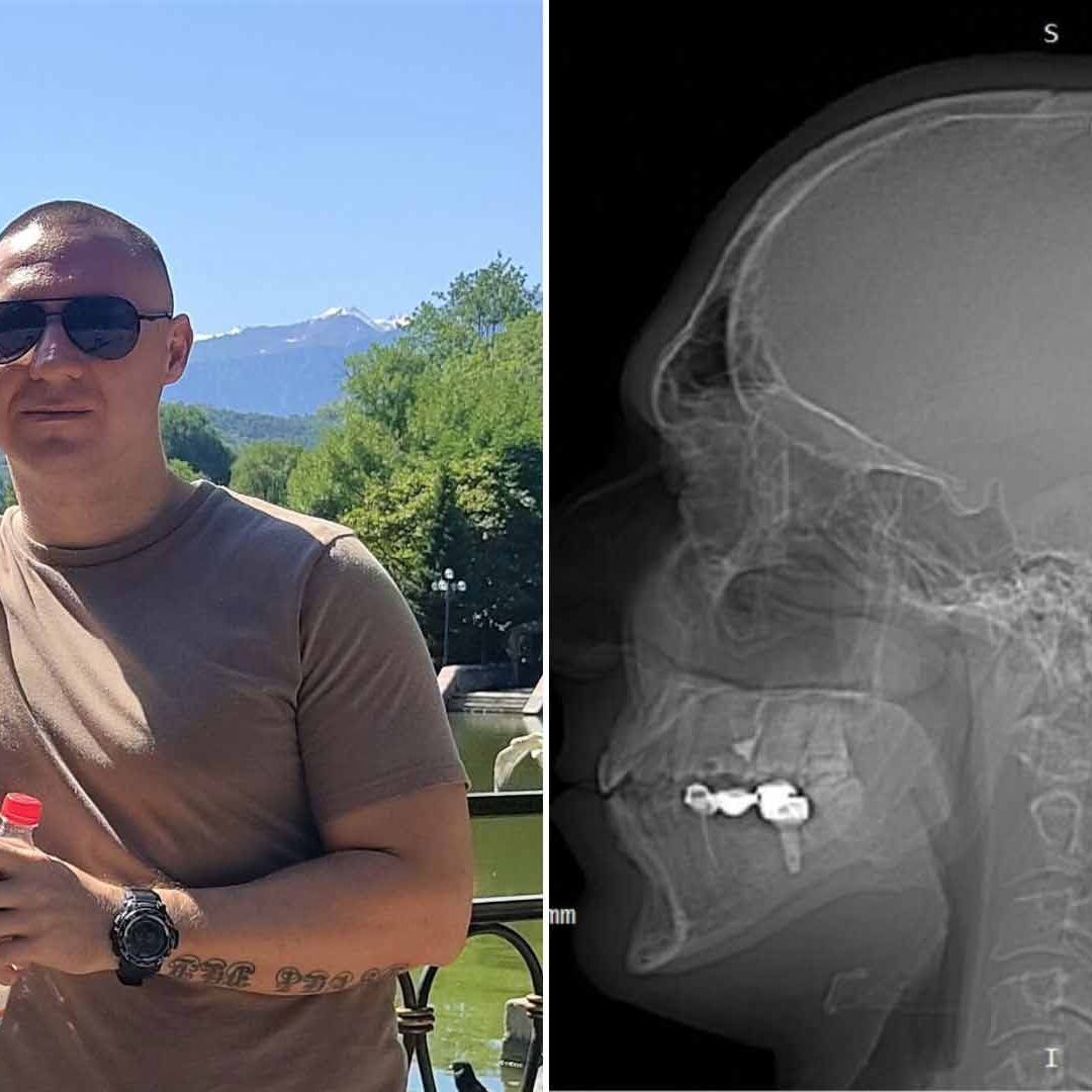 Hombre Se Perfora el Cráneo para ‘Controlar Sus Sueños’