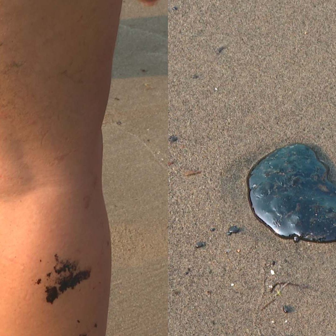 pierna de turista con hidrocarburo y mancha de chapopote