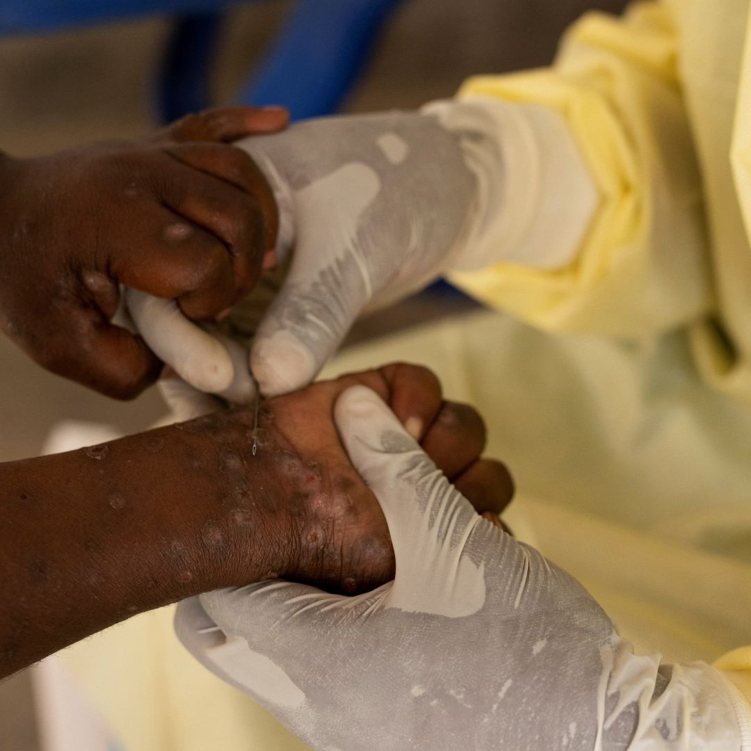 Mpox, emergencia de salud en África