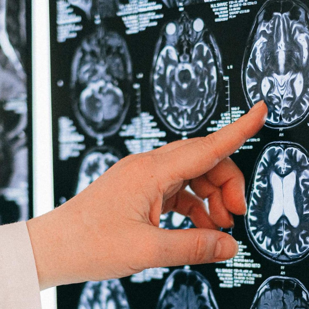 Plásticos en el Cerebro: Qué se Sabe de su Impacto