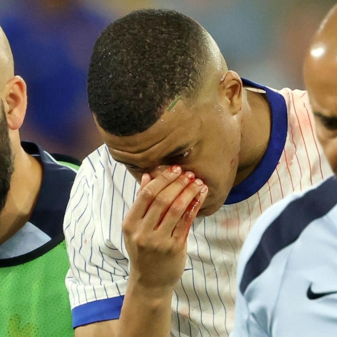 ¿Qué le Pasó a Mbappé? "Donatello" Bromea Con Máscara Tras Fractura de Nariz en la Euro 2024