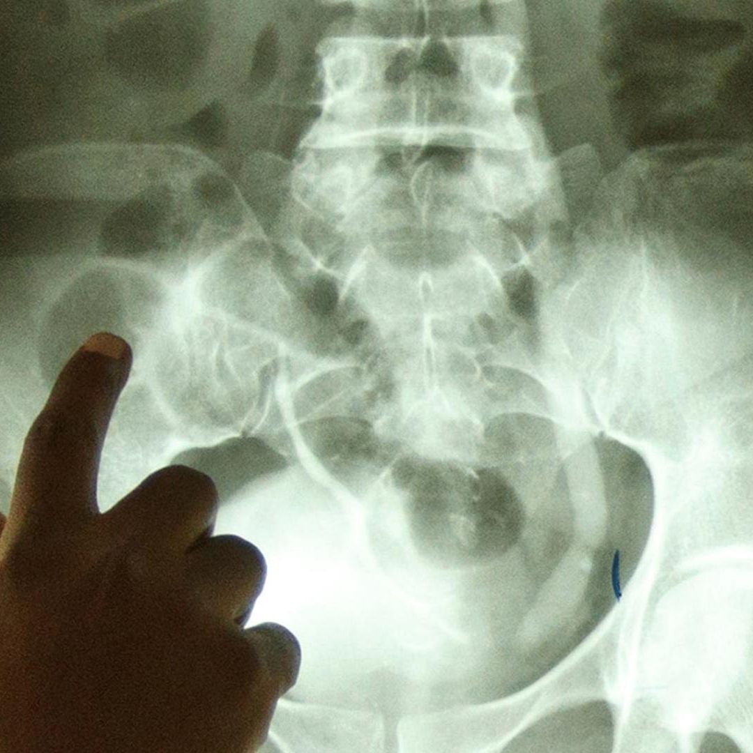 Radioterapeuta señala un tumor en una radiografía de un paciente con cáncer de vejiga, en 2012 en Ghana. Foto Reuters | Archivo
