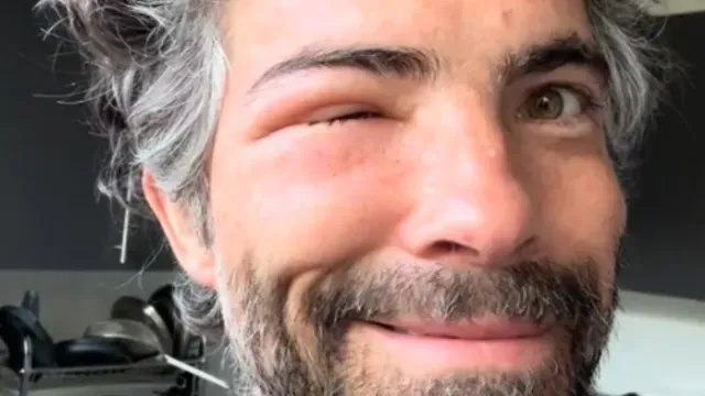 La aparente picadura de una abeja dejó así el rostro de Osvaldo Benavides. Foto: TikTok osvaldobenavidesoficial