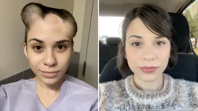 Alondra Sierra antes y después de su cirugía reconstructiva