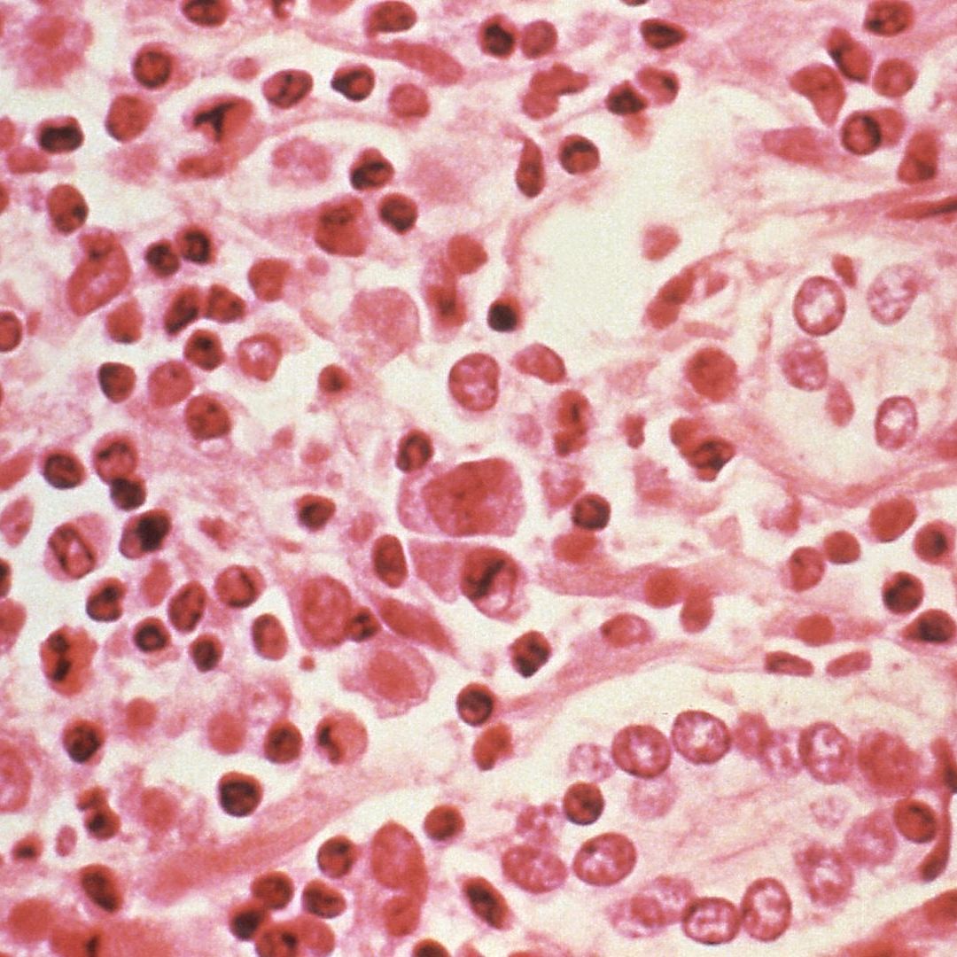 Hantavirus