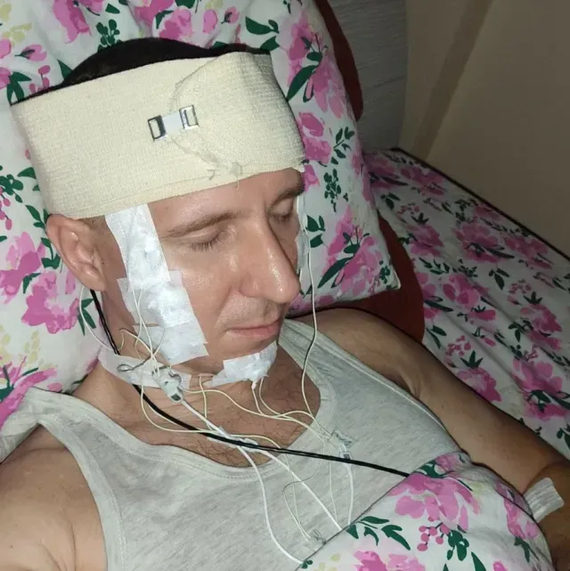 Michael Raduga: Hombre se perfora cráneo en Rusia