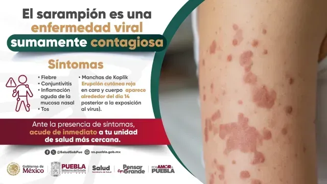 Salpullido característico del sarampión, comienza en rostro y sigue en el cuerpo. Foto: Salud Puebla