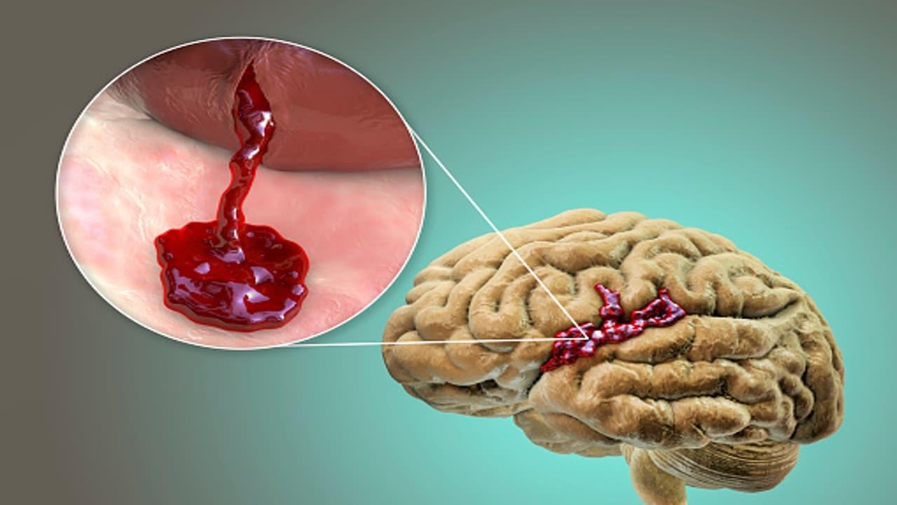 ¿Qué es un sangrado en el cerebro