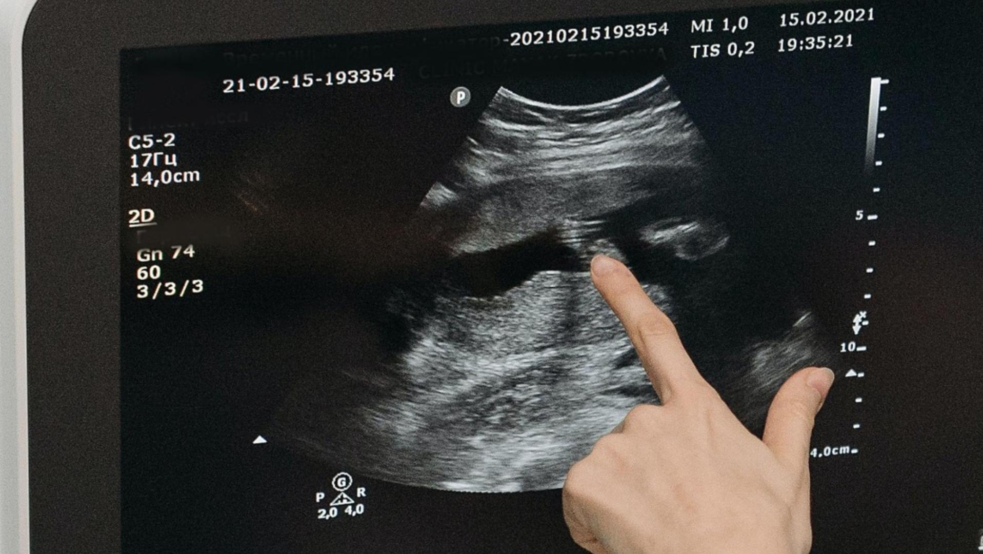 Abortar Fetos con Síndrome de Down, Ya Es Legal en Reino Unido | N+